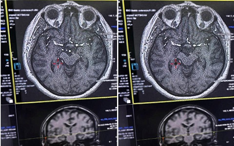 Рязанка испытала инсульт прямо во время похода в магазин