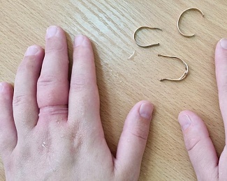 Рязанке из-за отеков при беременности пришлось срезать три кольца