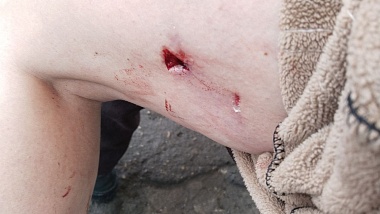 Фото не для слабонервных: стая бездомных псов искусала рязанку