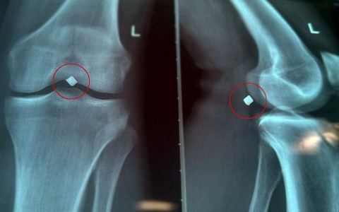 Врачи ОКБ помогли рязанцу с заставшим в зоне колена осколком