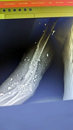 Рязанские врачи спасли руку мужчине с минно-взрывным ранением