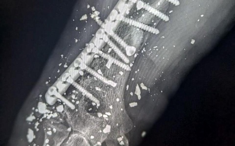 Рязанские врачи спасли руку мужчине с минно-взрывным ранением