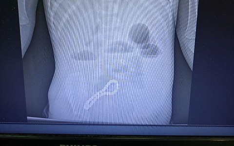 Трёхлетний малыш в Рязани проглотил магнитный браслет и едва не погиб