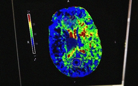В Рязанской ОКБ помогли пациентке с инсультом