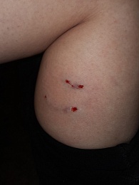 В Рязанской области женщина обращалась в БСМП из-за укуса бездомной собаки