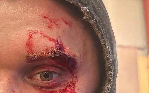 Директора рязанского Лесопарка Артёма Горячева ударили топором по голове Директора рязанского Лесопарка Артёма Горячева ударили топором по голове