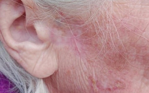 Врачи онкоцентра вылечили рецидив рака лица с помощью световой терапии