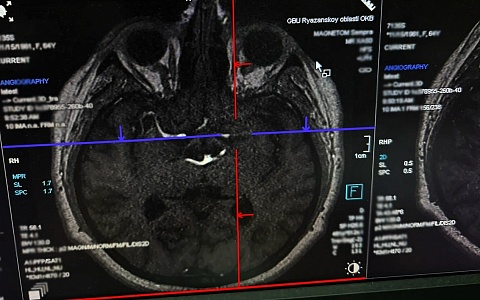 В Рязани врачи ОКБ 10 дней спасали 24-летнего вейпера с инсультом