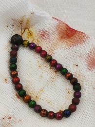 Трёхлетний малыш в Рязани проглотил магнитный браслет и едва не погиб