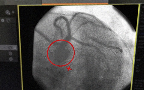 В Рязани мужчина едва не попал в ДТП из-за инфаркта