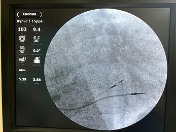 В Рязани освоили новый метод помощи "сердечникам"
