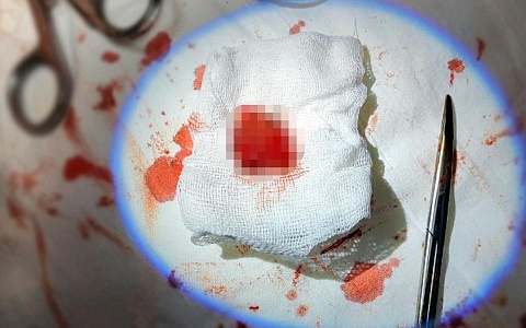 Врачи ОКБ сделали редкую операции молодой пациентке с опухолью на шее