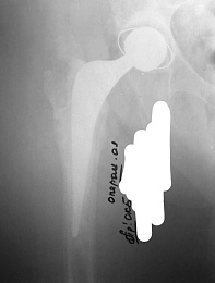 Рязанские врачи поставили на ноги пенсионерку после перелома шейки бедра